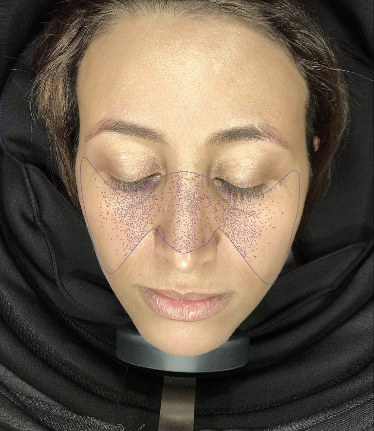 Analysefoto van de eerste huidlaag waarop poriegrootte en huidreliëf zichtbaar zijn.